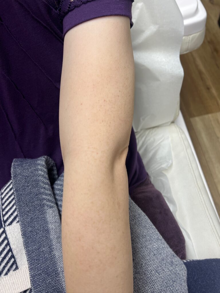 freckle removal on arms after