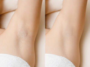 Laser-Treatment-For-Hair-Removal-Before-After Los Angeles