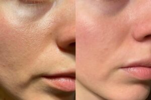 Microneedling for enlarged pores before-after Los Angeles