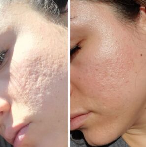 Morpheus 8 before-after enlarged pores Los Angeles 