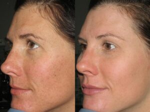 benefits of IPL photofacial for enlarged pores Los Angeles benefits of IPL photofacial for enlarged pores Los Angeles 