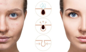 how get rid of dilated pores Los Angeles 