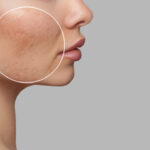professional treatments to reduce dilated pores Los Angeles