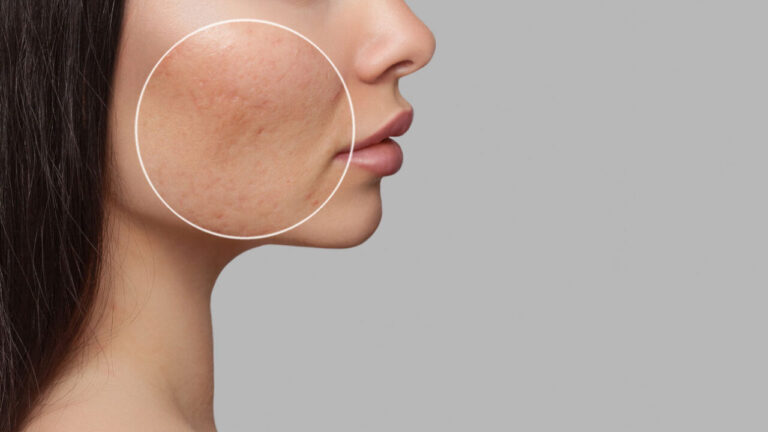 professional treatments to reduce dilated pores Los Angeles