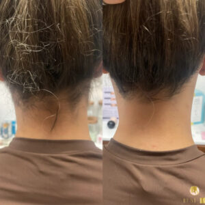 unwanted hair removal Los Angeles