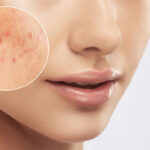 Fading facial scars with Morpheus8 Los Angeles