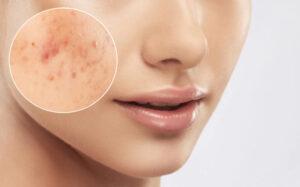 Fading facial scars with Morpheus8 Los Angeles