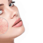 Lumecca IPL for facial broken capillaries Los Angeles