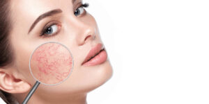 Lumecca IPL for facial broken capillaries Los Angeles