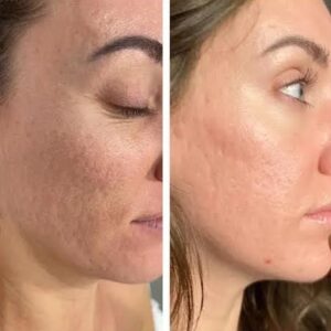 Morpheus8 for facial scars before-after Los Angeles