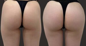 Sculptra-injections-for-deep-hip-dips Los Angeles