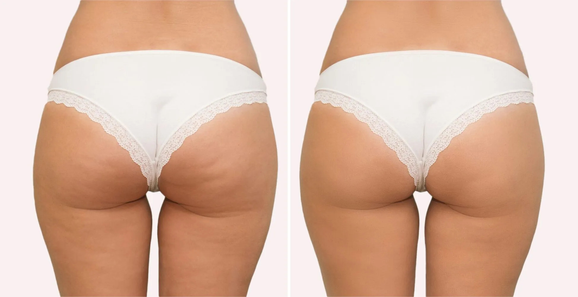 non-surgical-Sculptra-butt-lift-before-after Los Angeles