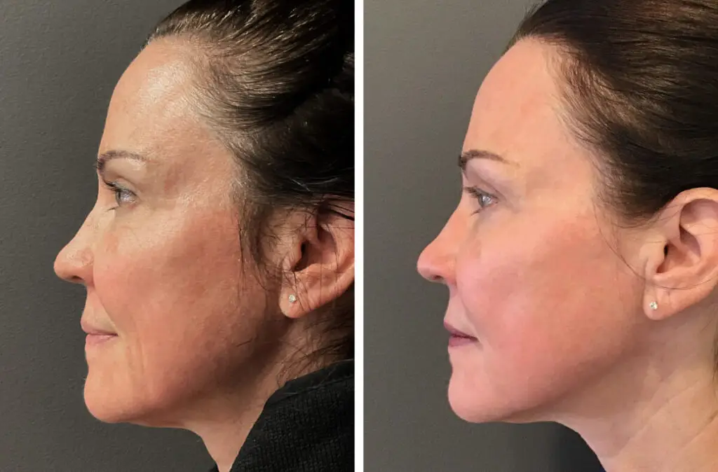 CO2 laser resurfacing before-after Los Angeles