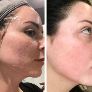 CO2 laser treatment before-after Los Angeles