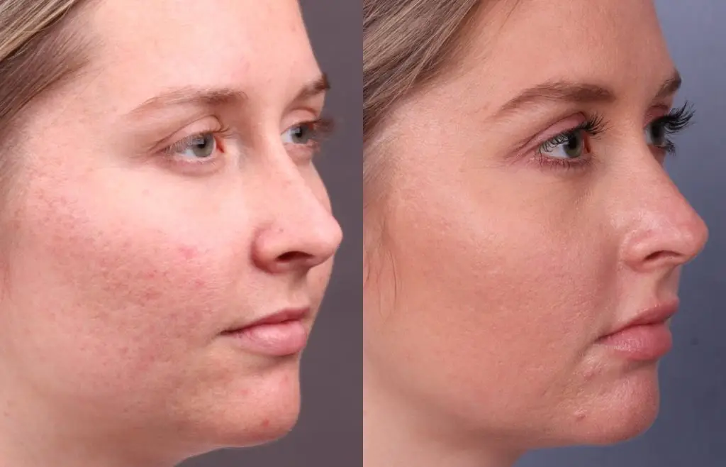 CO2 skin treatment Los Angeles