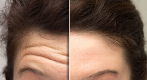 Forehead creases treatment with fillers Los Angeles