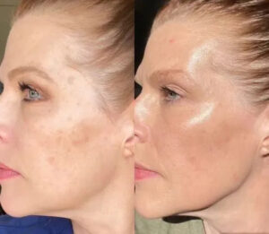 benefits of NAD injections Los Angeles (1)
