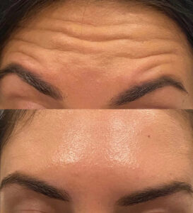 dermal fillers for forehead lines before-after Los Angeles