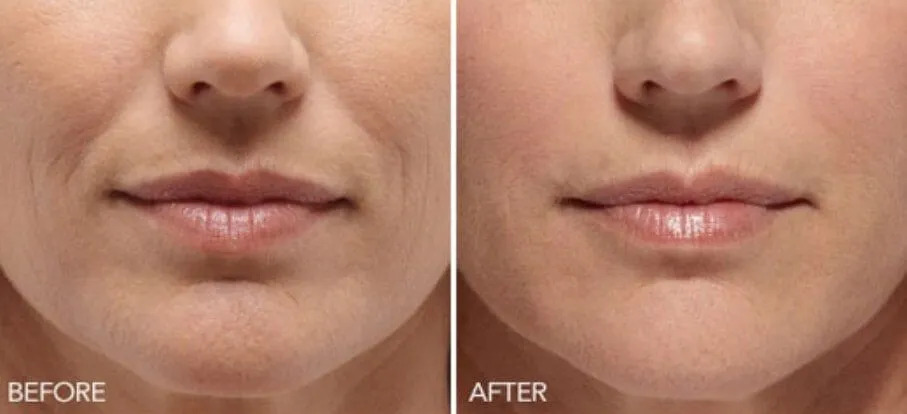 dermal fillers for smile lines before-after Los Angeles