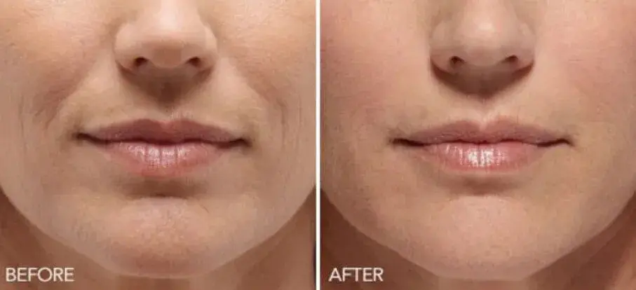 dermal fillers for smile lines before-after Los Angeles