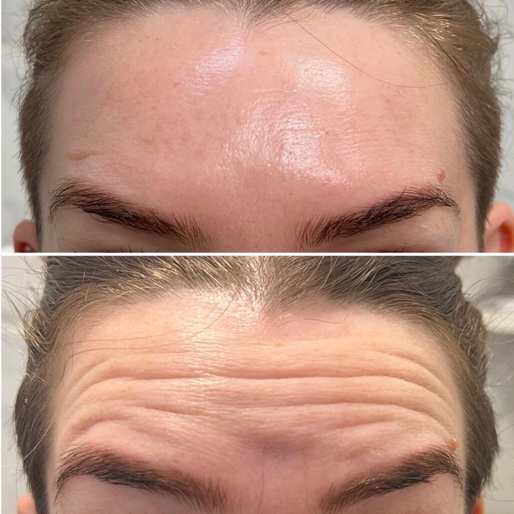 forehead fillers before-after Los Angeles