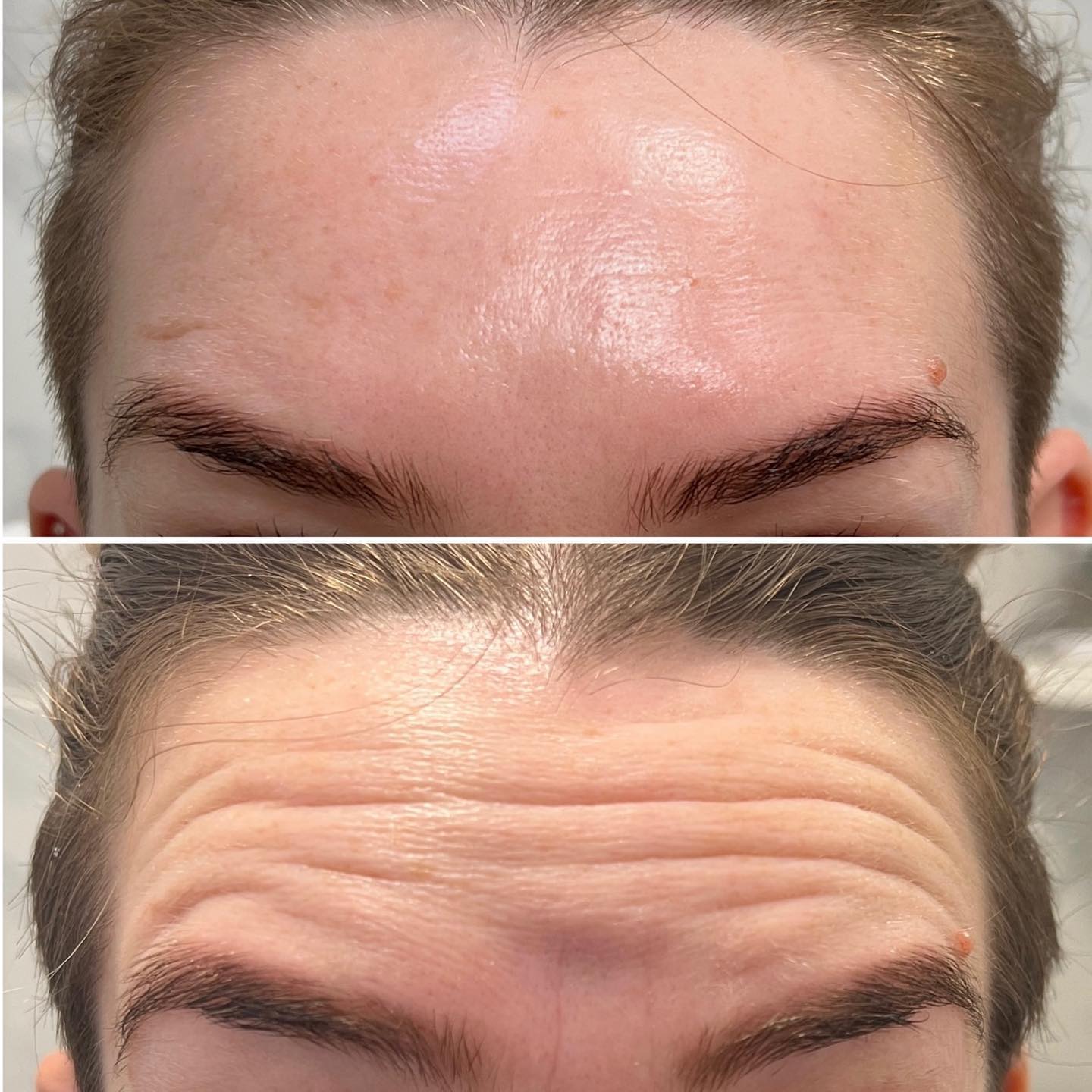 forehead fillers before-after Los Angeles