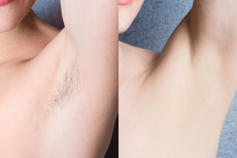 laser hair removal before-after Los Angeles