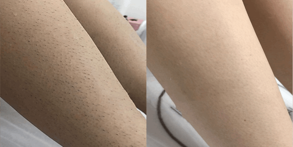 laser-hair-removal-legs Los Angeles