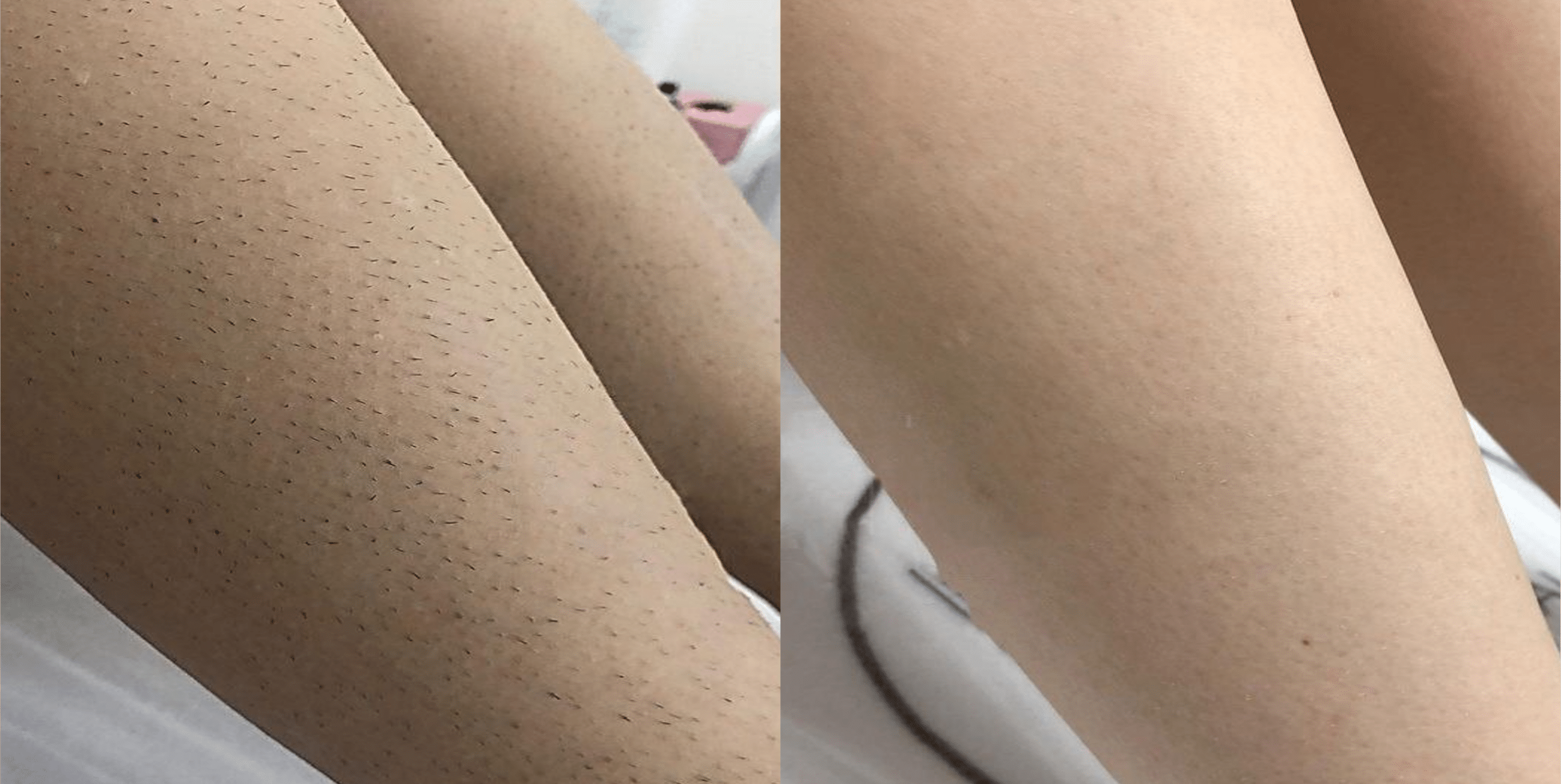 laser-hair-removal-legs Los Angeles