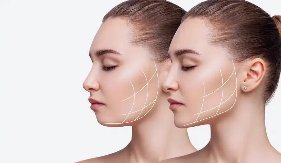 Chin fillers for facial harmony and jawline definition Los Angeles