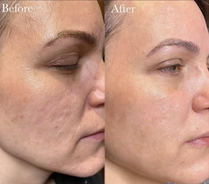 CoolPeel-skin-tightening-Los Angeles
