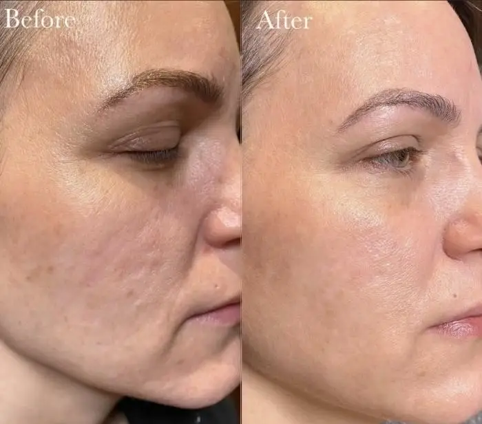 CoolPeel-skin-tightening-Los Angeles