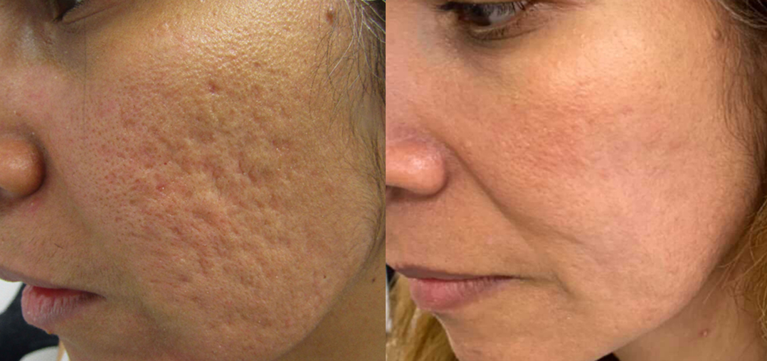 Microneedling for facial scars Los Angeles