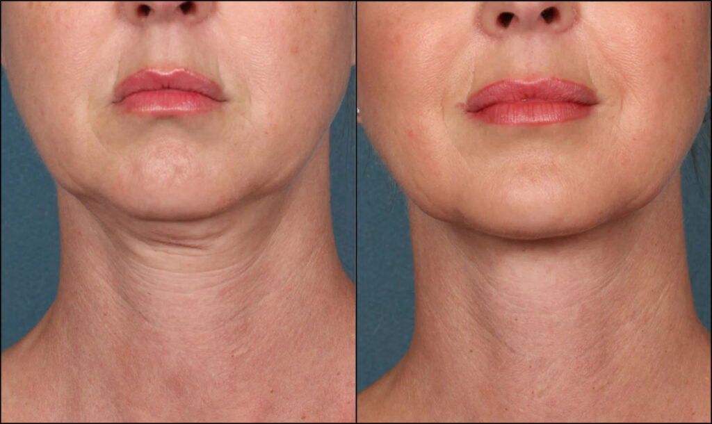 Microneedling for skin tightening before-after Los Angeles