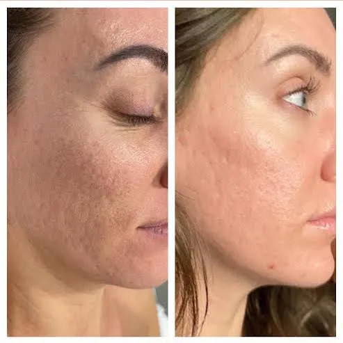 Morpheus8 for facial scarring before-after Los Angeles