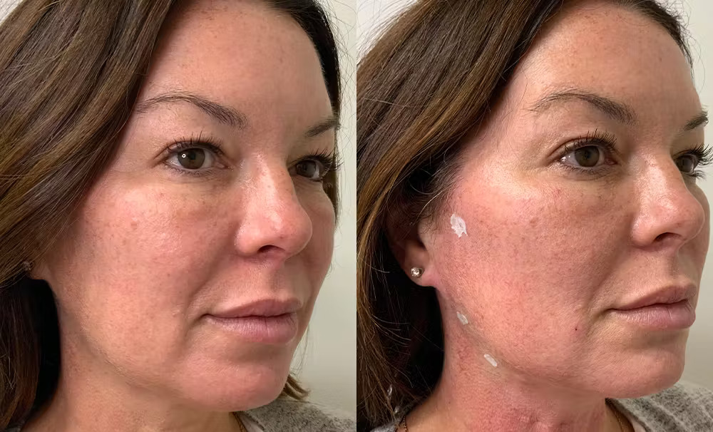 PDO threads-skin-tightening-treatments Los Angeles