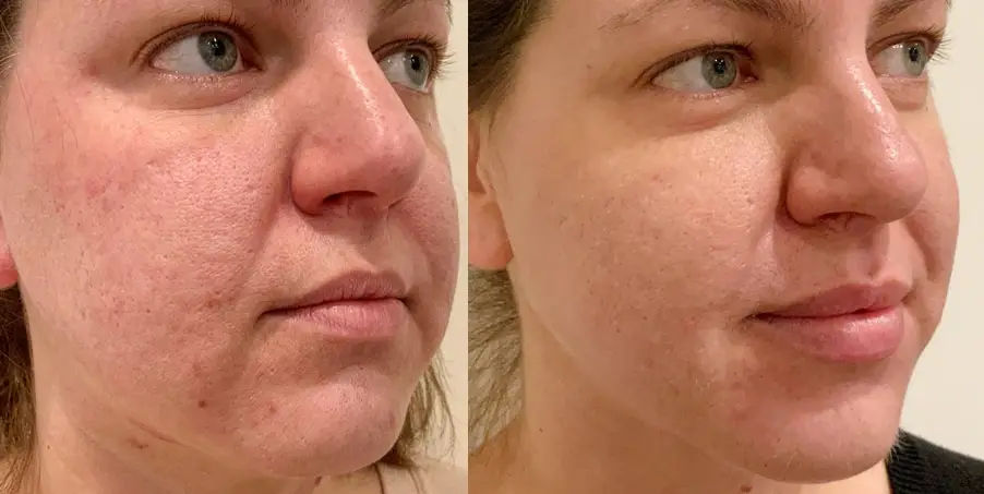 PRX-T33-skin-tightening-treatments-Los Angeles