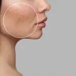 Top non-surgical solutions for face scarring Los Angeles