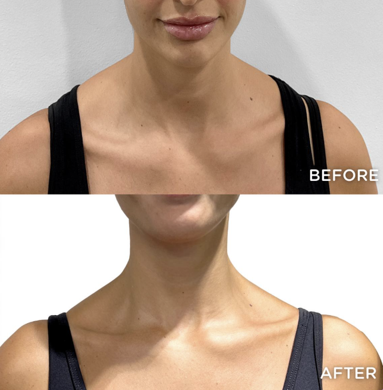 Traptox-Barbie Botox-before-after Los Angeles