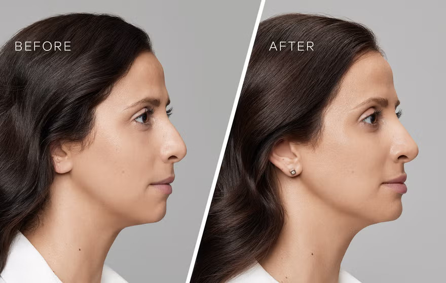 benefits of chin fillers Los Angeles