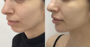 chin augmentation with dermal fillers Los Angeles