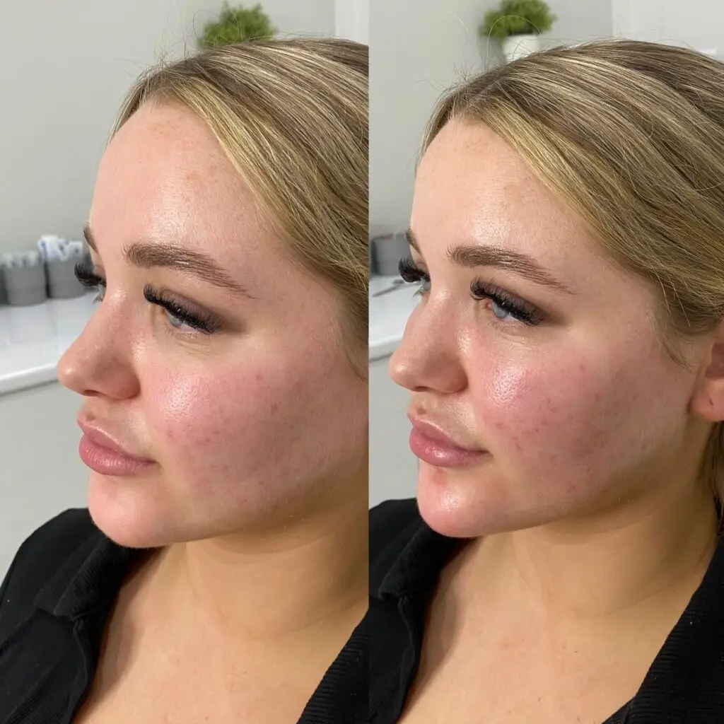 chin dermal filler Los Angeles