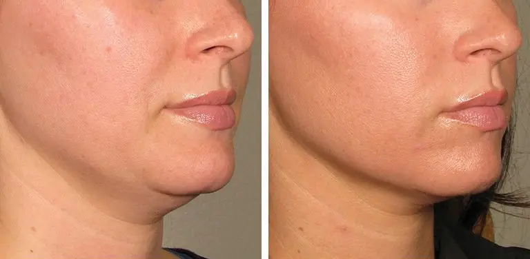 sagging skin treatment with Morpheus8 Los Angeles