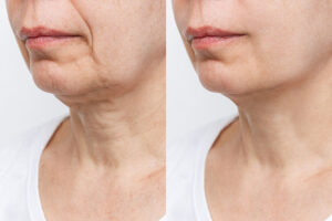 Lower part of the face and neck of elderly woman with signs of s