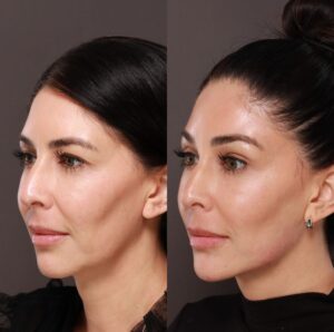 enhance your facial contour with jawline fillers Los Angeles