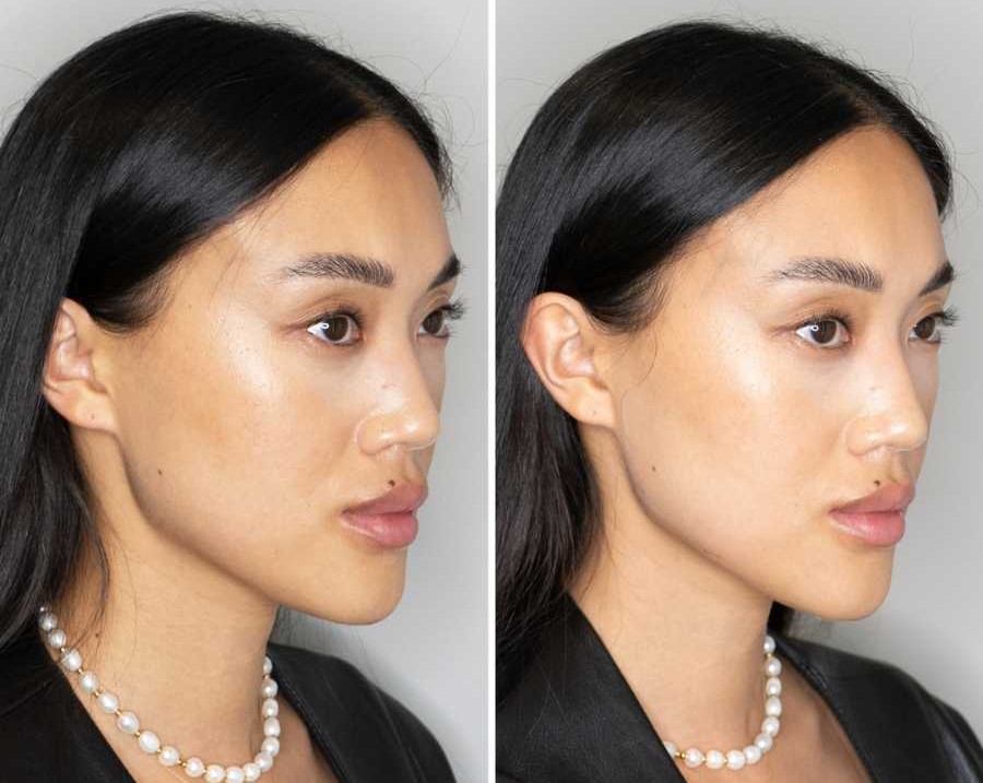 jaw filler before-after Los Angeles