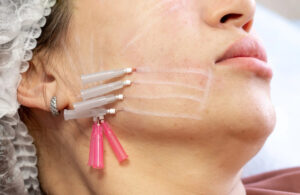 non-surgical skin lift with PDO threads Los Angeles