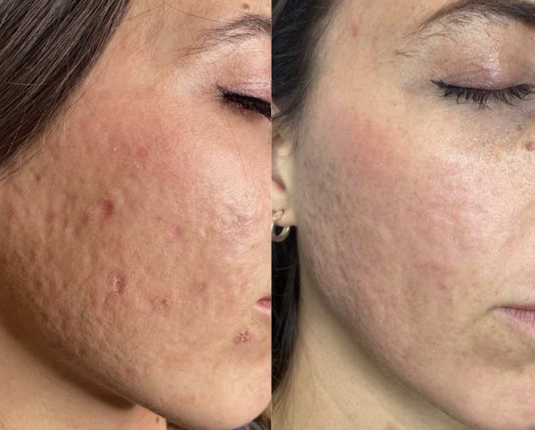 Cool Peel for scars on face Los Angeles 3