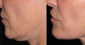 Morpheus8-non-surgical-chin-fat-removal-before-and-after-Los Angeles