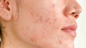 Non-surgical treatments for scars on face Los Angeles 